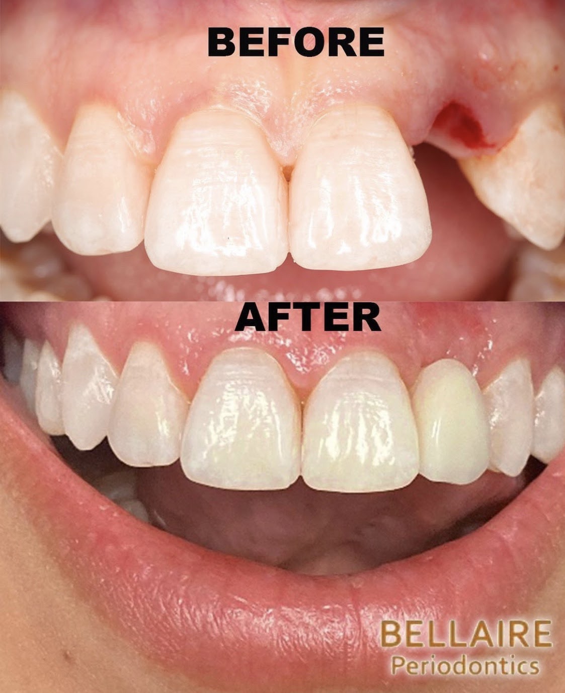 before and after image of healthy teeth