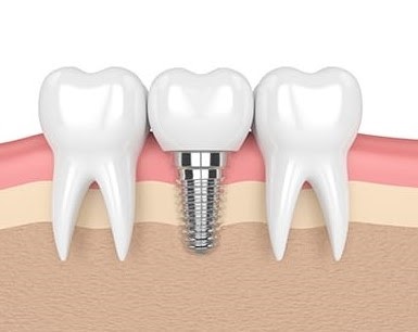Dental Implants graphic