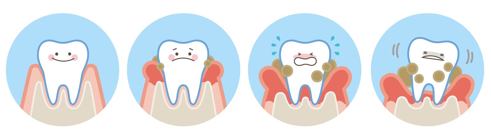 Importance of Periodontal Maintenance