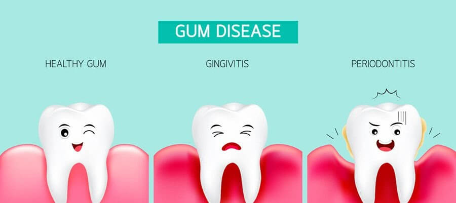 Gum Disease graphic