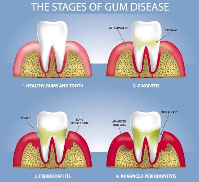 The Stages of Gum Disease