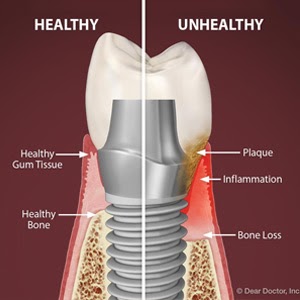Implant Gum Disease graphic