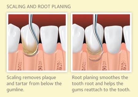 Scaling and root planing