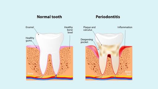 Normal teeth vs Periodontitis